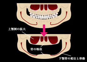 下顎洞の拡大